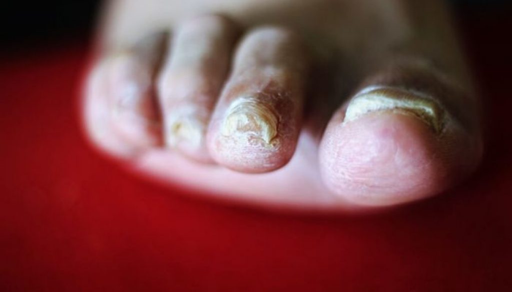 ongles de pieds jaunes